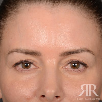 Eyelid Surgery Before & After Gallery - Patient 271984 - Image 1