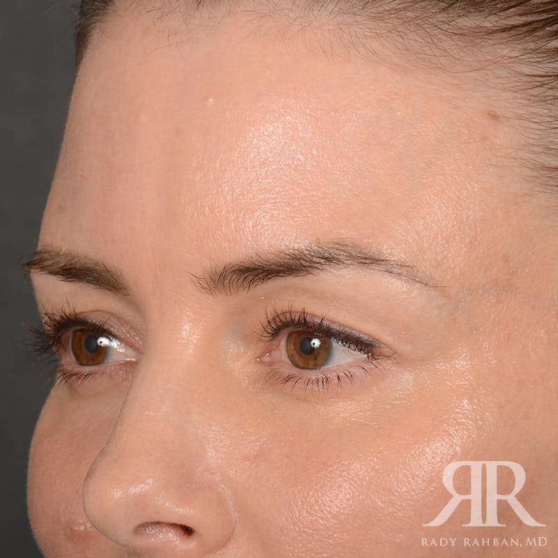 Eyelid Surgery Before & After Gallery - Patient 271984 - Image 3