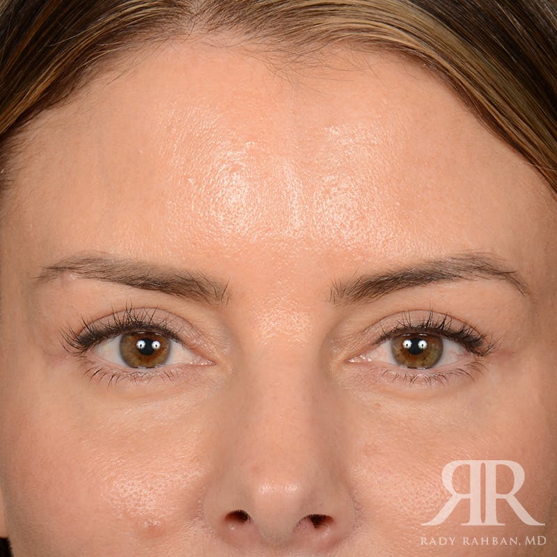 Eyelid Surgery Before & After Gallery - Patient 271984 - Image 2