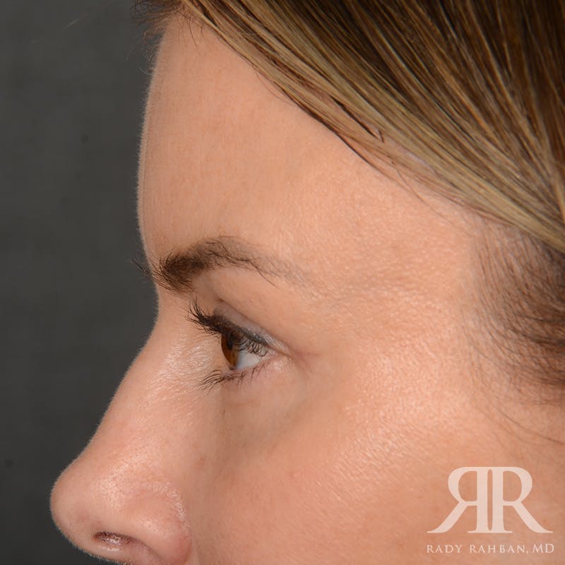 Eyelid Surgery Before & After Gallery - Patient 271984 - Image 6
