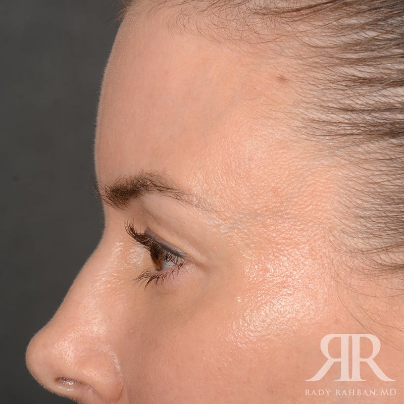 Eyelid Surgery Before & After Gallery - Patient 271984 - Image 5