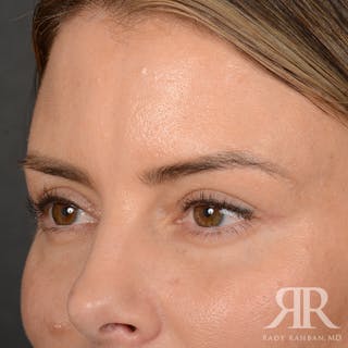 Eyelid Surgery Before & After Gallery - Patient 271984 - Image 4