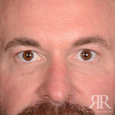 Eyelid Surgery Before & After Gallery - Patient 250806 - Image 1