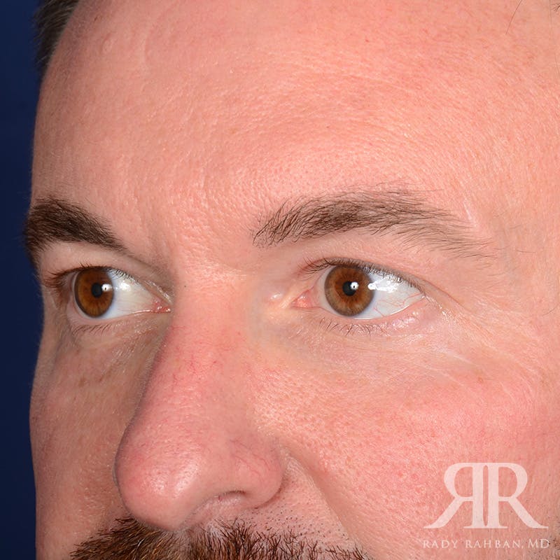 Eyelid Surgery Before & After Gallery - Patient 250806 - Image 3