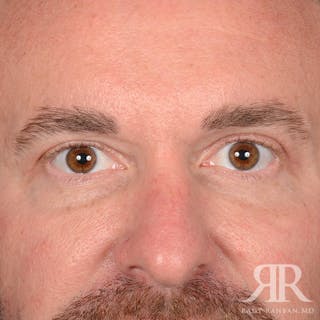 Eyelid Surgery Before & After Gallery - Patient 250806 - Image 2