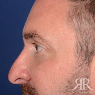 Eyelid Surgery Before & After Gallery - Patient 250806 - Image 6