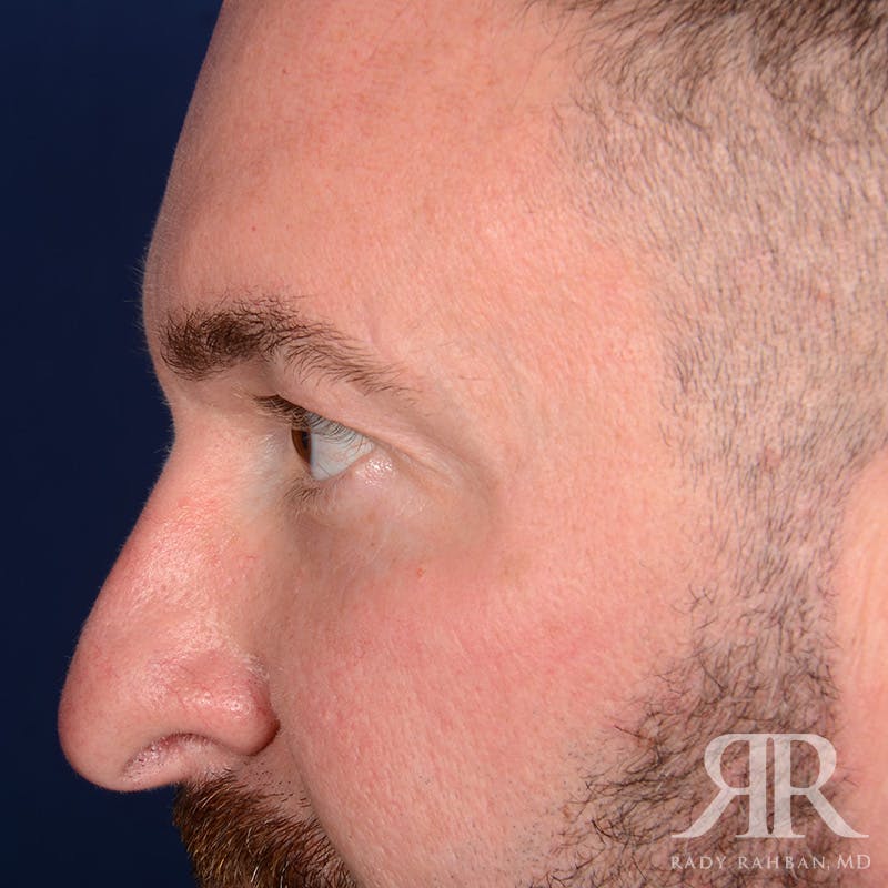 Eyelid Surgery Before & After Gallery - Patient 250806 - Image 5