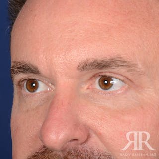 Eyelid Surgery Before & After Gallery - Patient 250806 - Image 4