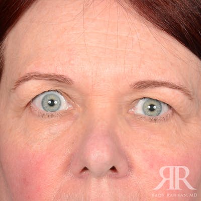 Eyelid Surgery Before & After Gallery - Patient 920361 - Image 1