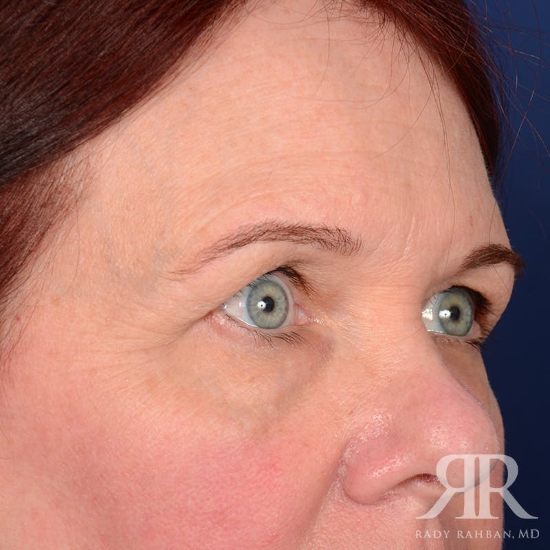 Eyelid Surgery Before & After Gallery - Patient 920361 - Image 3
