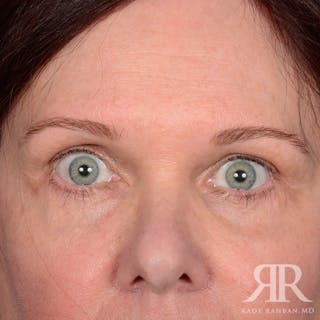 Eyelid Surgery Before & After Gallery - Patient 920361 - Image 2