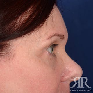 Eyelid Surgery Before & After Gallery - Patient 920361 - Image 6
