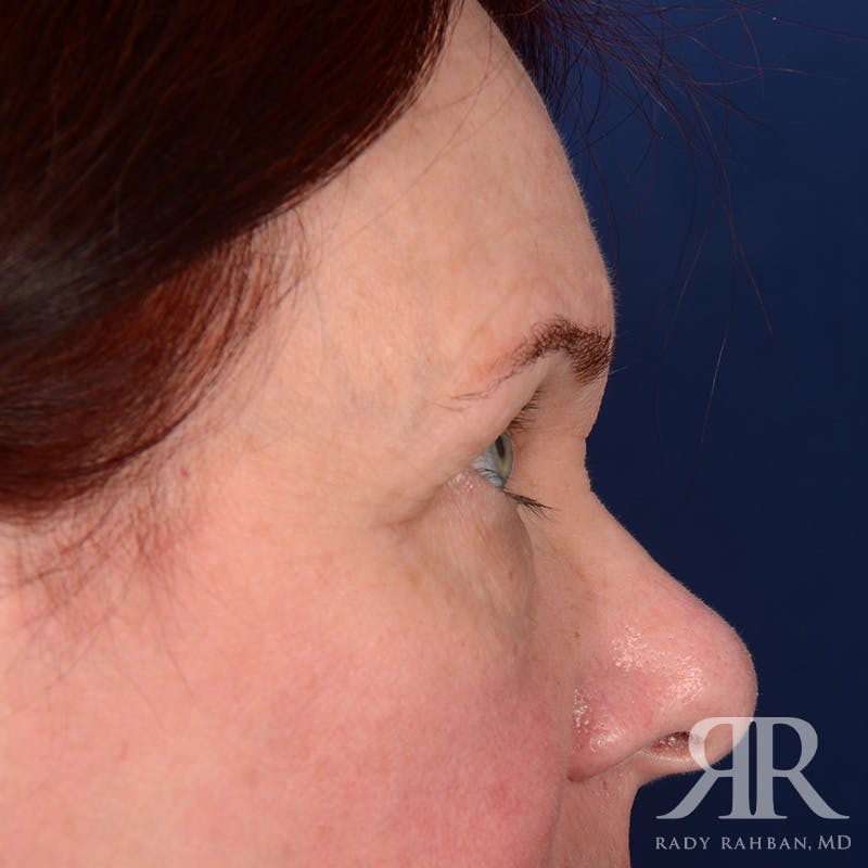 Eyelid Surgery Before & After Gallery - Patient 920361 - Image 5
