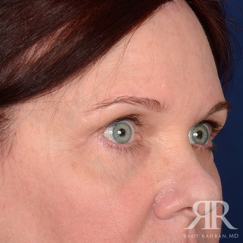 Eyelid Surgery Before & After Gallery - Patient 920361 - Image 4
