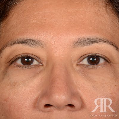 Eyelid Surgery Before & After Gallery - Patient 398623 - Image 1