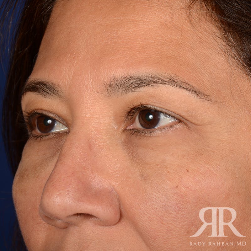 Eyelid Surgery Before & After Gallery - Patient 398623 - Image 3