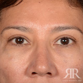 Eyelid Surgery Before & After Gallery - Patient 398623 - Image 2