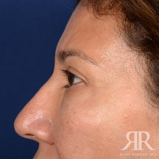 Eyelid Surgery Before & After Gallery - Patient 398623 - Image 6