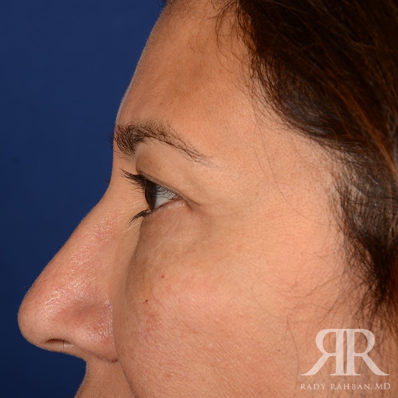 Eyelid Surgery Before & After Gallery - Patient 398623 - Image 5