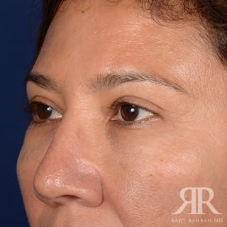 Eyelid Surgery Before & After Gallery - Patient 398623 - Image 4