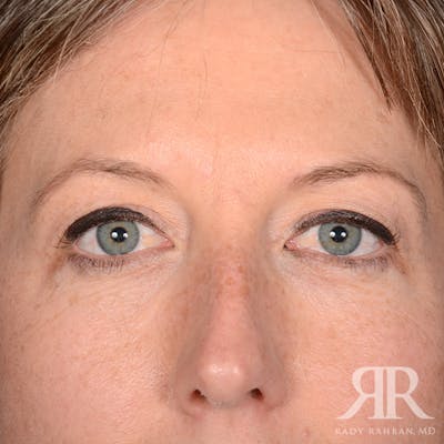 Eyelid Surgery Before & After Gallery - Patient 910635 - Image 1
