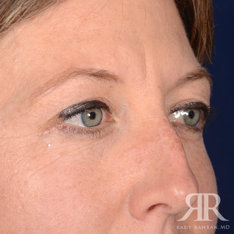 Eyelid Surgery Before & After Gallery - Patient 910635 - Image 3