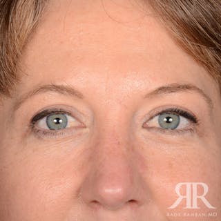 Eyelid Surgery Before & After Gallery - Patient 910635 - Image 2