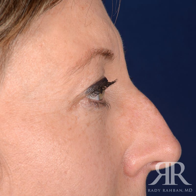 Eyelid Surgery Before & After Gallery - Patient 910635 - Image 5