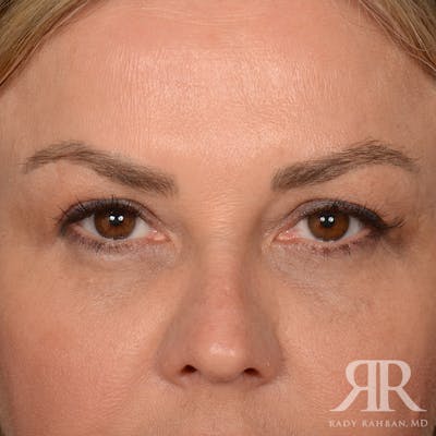 Eyelid Surgery Before & After Gallery - Patient 305428 - Image 1