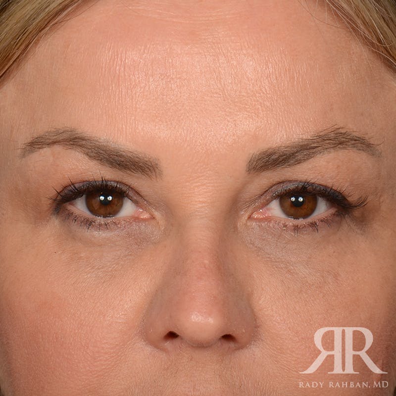 Eyelid Surgery Before & After Gallery - Patient 305428 - Image 1