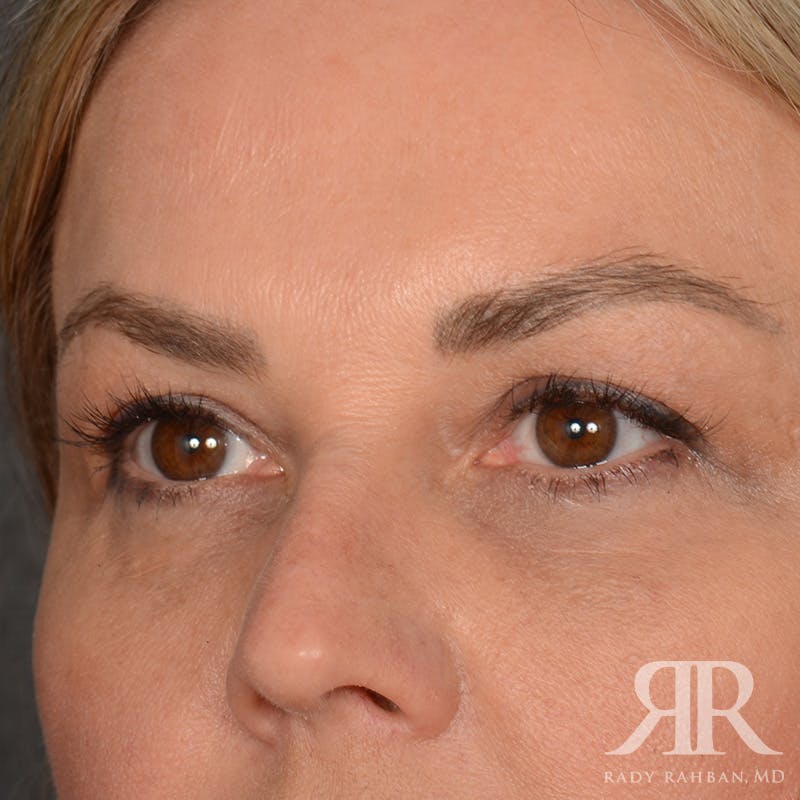 Eyelid Surgery Before & After Gallery - Patient 305428 - Image 3