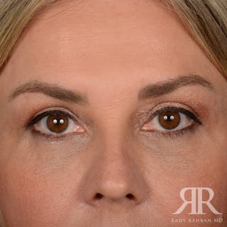 Eyelid Surgery Before & After Gallery - Patient 305428 - Image 2