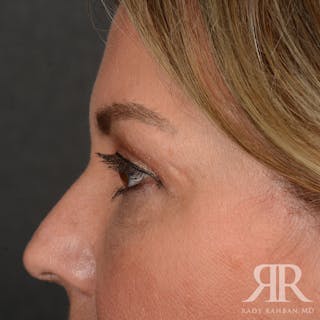 Eyelid Surgery Before & After Gallery - Patient 305428 - Image 6