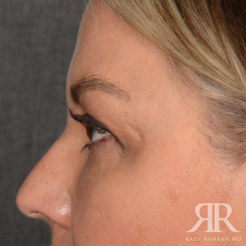 Eyelid Surgery Before & After Gallery - Patient 305428 - Image 5