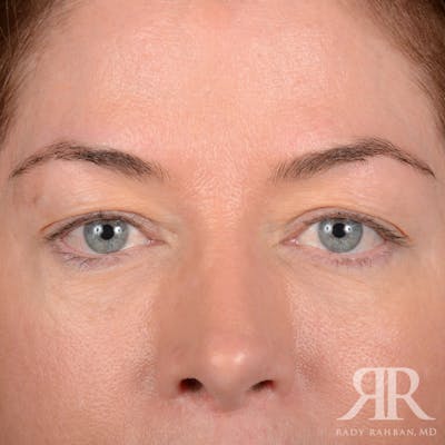 Eyelid Surgery Before & After Gallery - Patient 113578 - Image 1