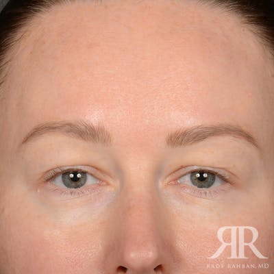 Eyelid Surgery Before & After Gallery - Patient 305943 - Image 1