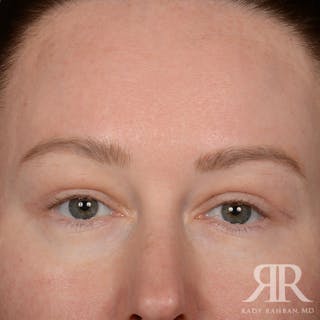 Eyelid Surgery Before & After Gallery - Patient 305943 - Image 2