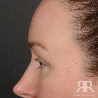 Eyelid Surgery Before & After Gallery - Patient 305943 - Image 6