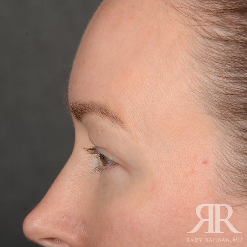 Eyelid Surgery Before & After Gallery - Patient 305943 - Image 5