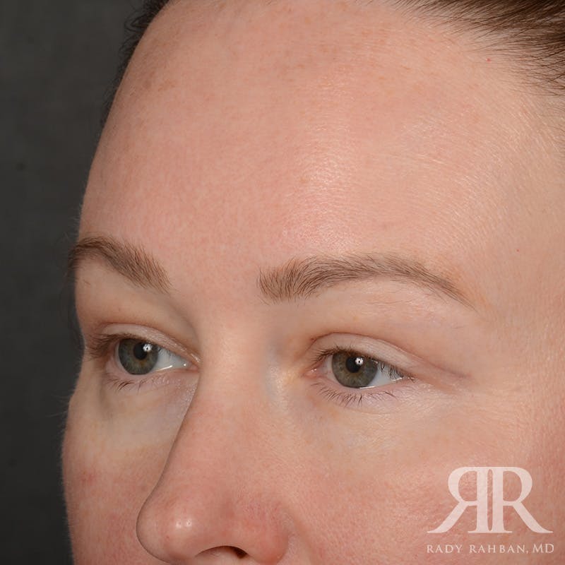 Eyelid Surgery Before & After Gallery - Patient 305943 - Image 4