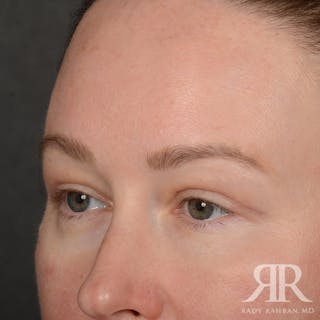 Eyelid Surgery Before & After Gallery - Patient 305943 - Image 4