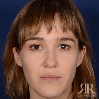 Female Rhinoplasty Before & After Gallery - Patient 161880 - Image 1