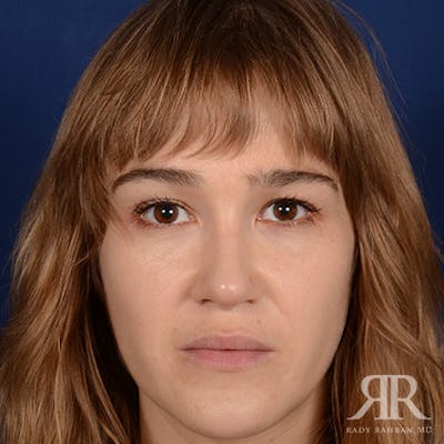 Female Rhinoplasty Before & After Gallery - Patient 161880 - Image 2