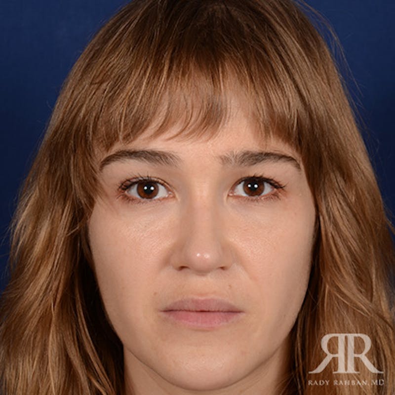 Female Rhinoplasty Before & After Gallery - Patient 161880 - Image 2