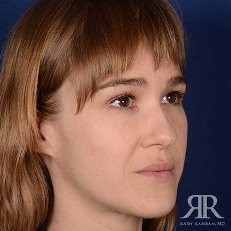 Female Rhinoplasty Before & After Gallery - Patient 161880 - Image 3