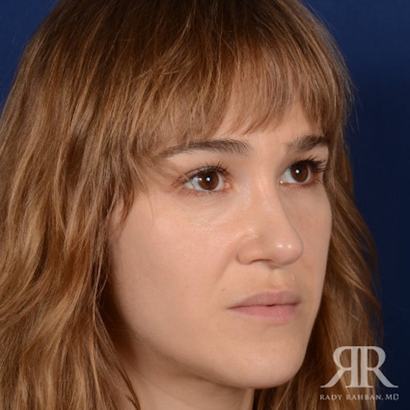 Female Rhinoplasty Before & After Gallery - Patient 161880 - Image 4