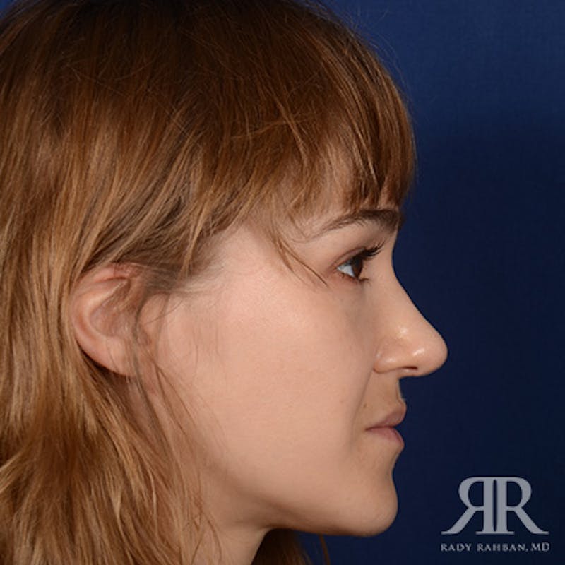 Female Rhinoplasty Before & After Gallery - Patient 161880 - Image 5