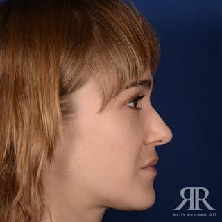 Female Rhinoplasty Before & After Gallery - Patient 161880 - Image 6