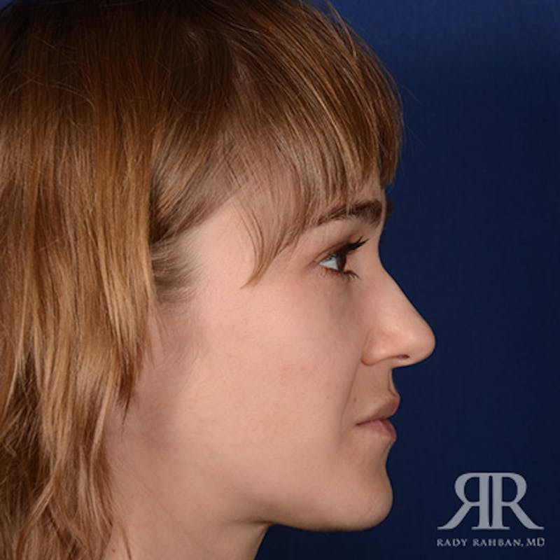 Female Rhinoplasty Before & After Gallery - Patient 161880 - Image 6
