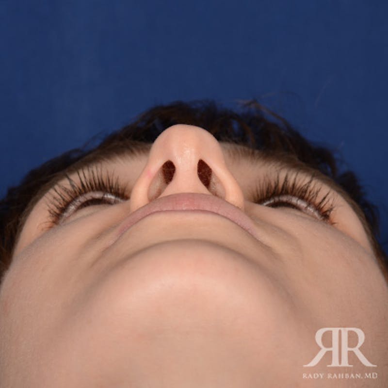 Female Rhinoplasty Before & After Gallery - Patient 161880 - Image 7